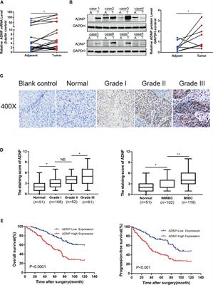 ADNP Upregulation Promotes Bladder Cancer Cell Proliferation via the AKT Pathway